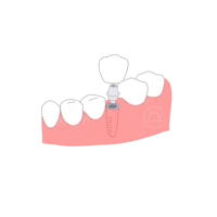 Ilustración de Carillas