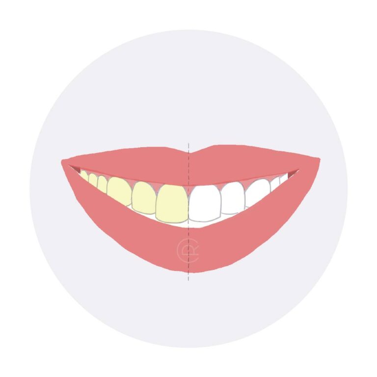 blanqueamiento dental ambulatorio