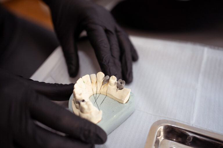 ¿Se me despegó una corona o un puente dental? Qué hacer en casa y cuándo ir al consultorio (Recoleta, CABA)